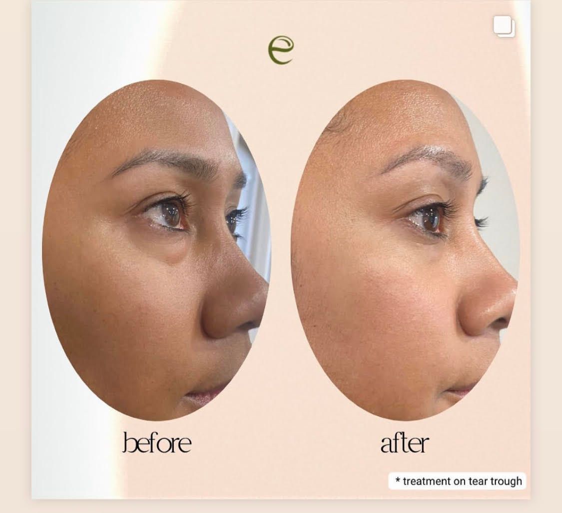 Evangeline Before & After Treatment
