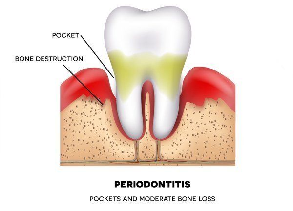 10 Facts About Periodontitis You May Not Know