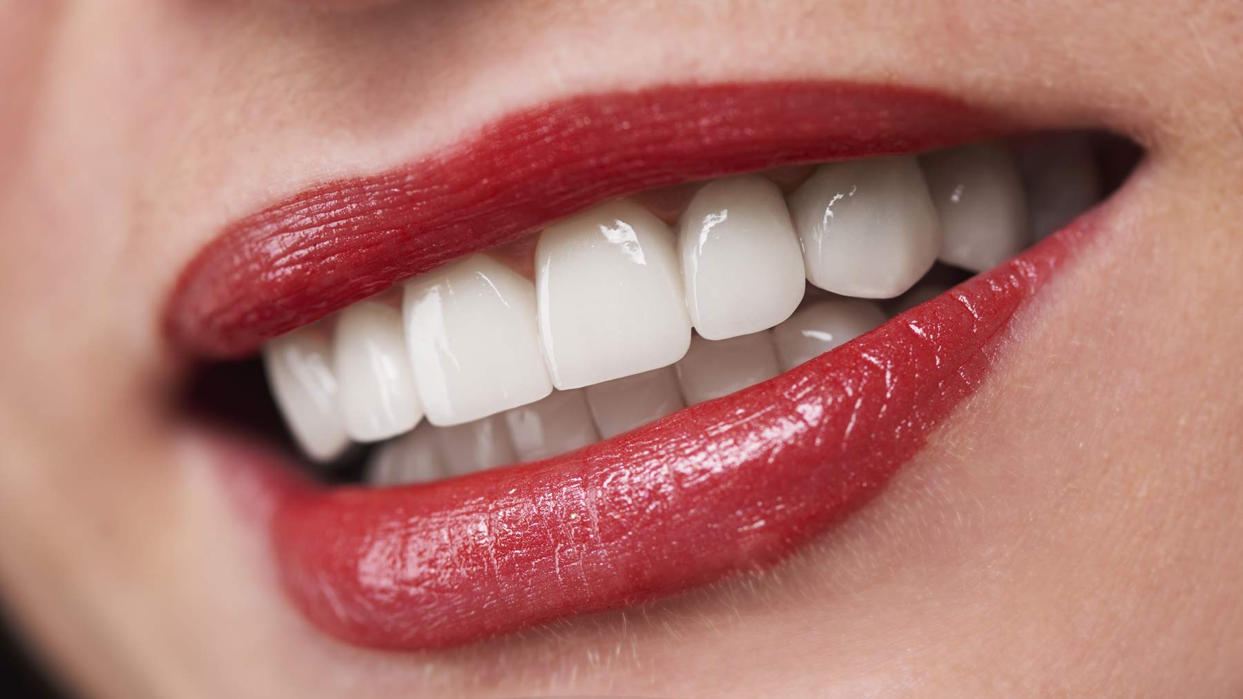 All-On-4 Dental Implants - Dr. Stephanie Sfiroudis New Teeth in a Day!