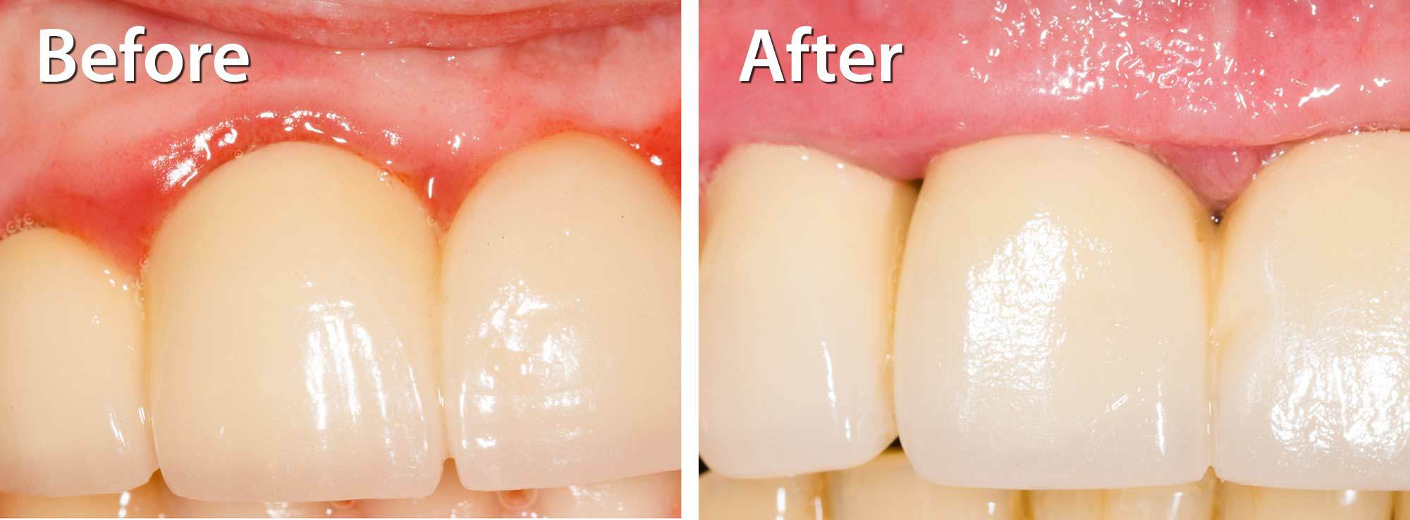 Cosmetic Crown Lengthening by Nassau County Periodontist Dr. Stephanie Sfiroudis DDS, MS