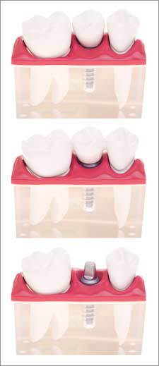 Diagram of what is done when receiving Dental Implants by Nassau County Periodontist, Dr. Marichia Attalla.