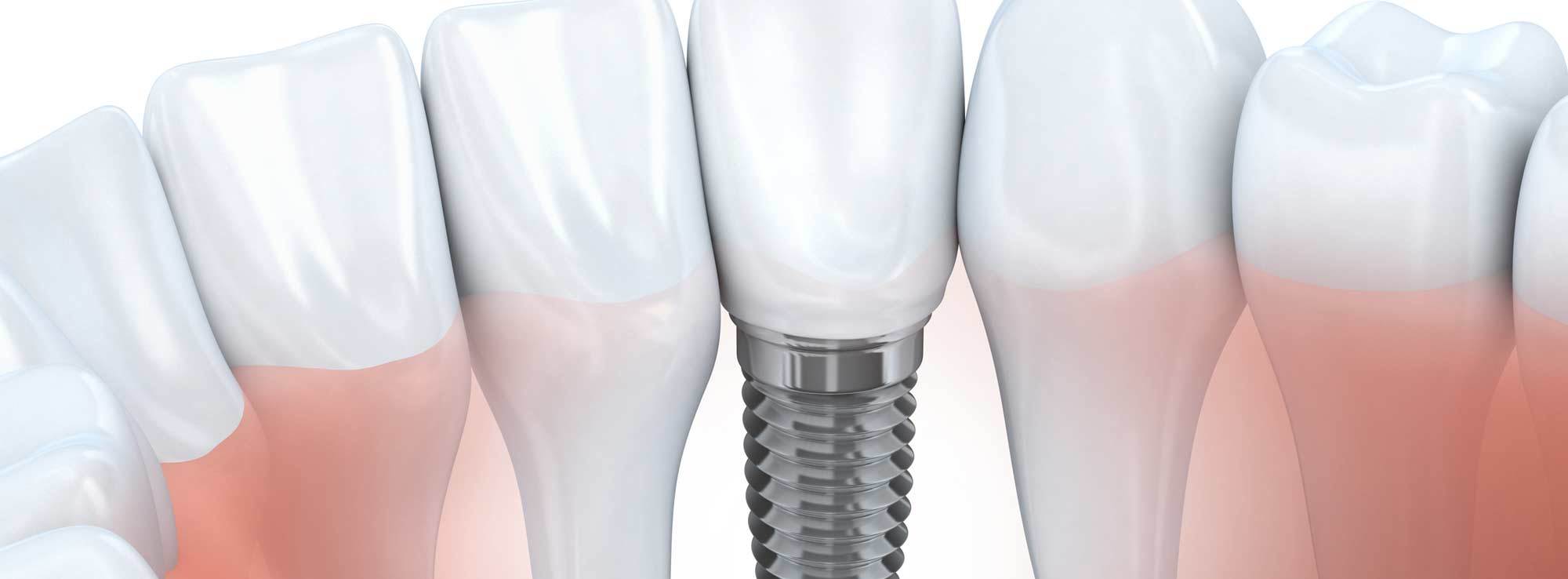 Dental Implants by Nassau County Periodontist Dr. Stephanie Sfiroudis DDS, MS