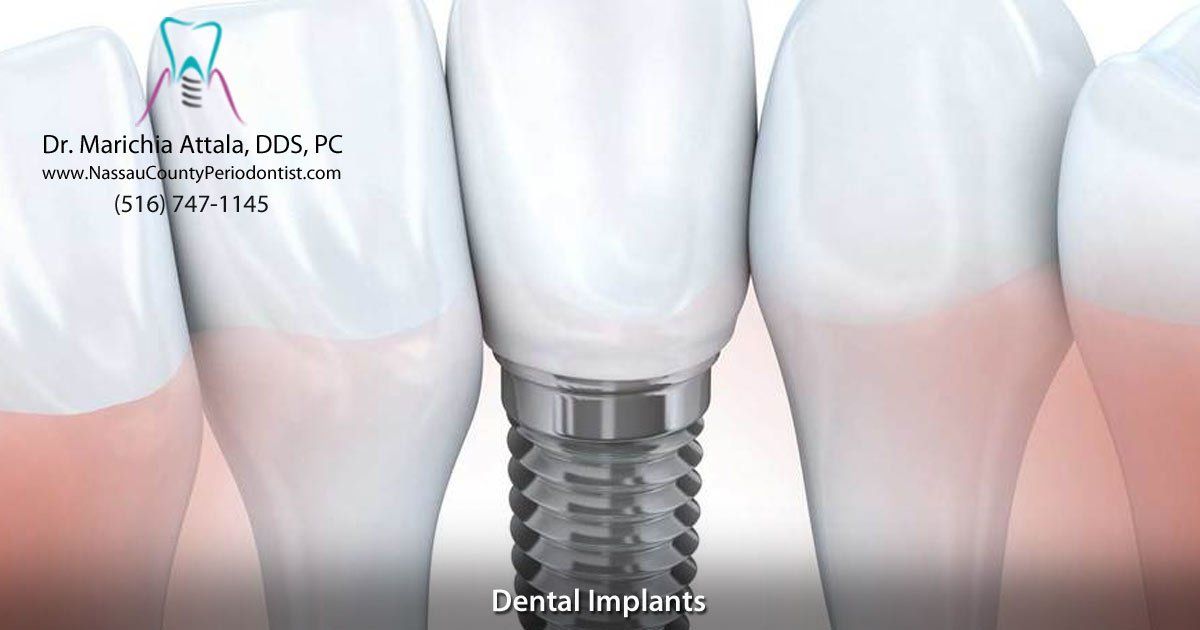 Dental Implants By Periodontist Dr Marichia Attalla Dental Implants By Periodontist Dr Marichia Attalla