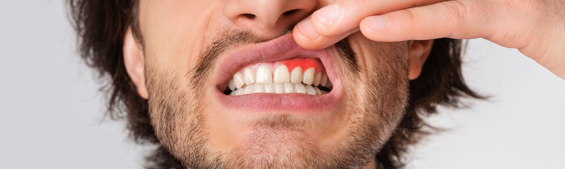 Man with inflamed gums from Gingivitis