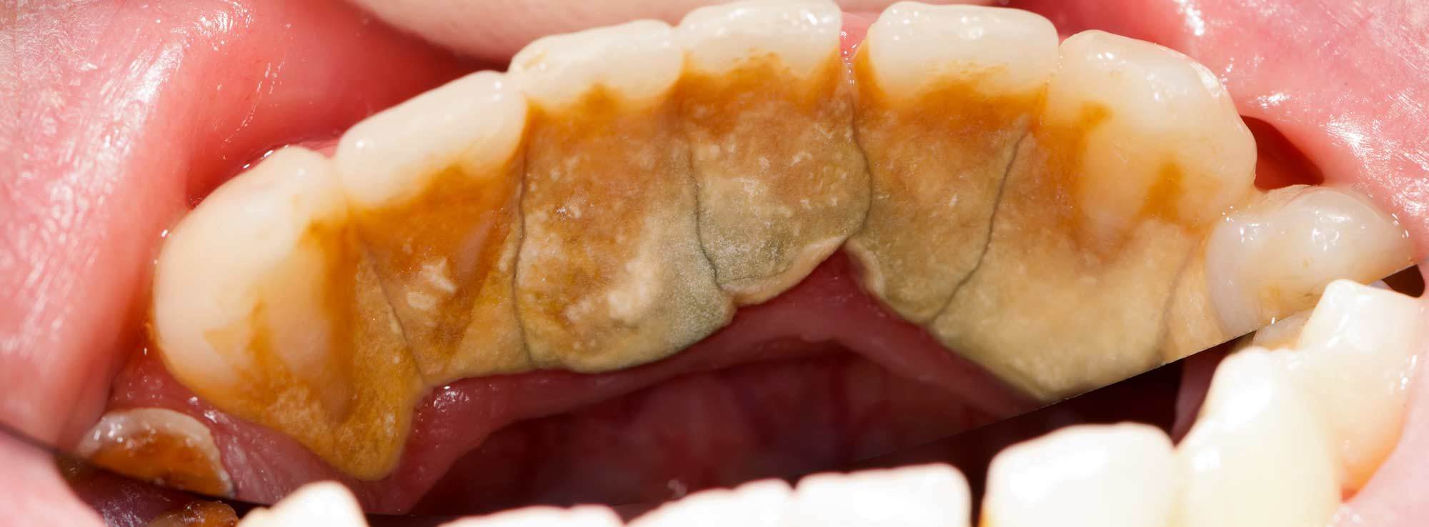 Gum Disease Treatment by Nassau County Periodontist Dr. Stephanie Sfiroudis DDS, MS
