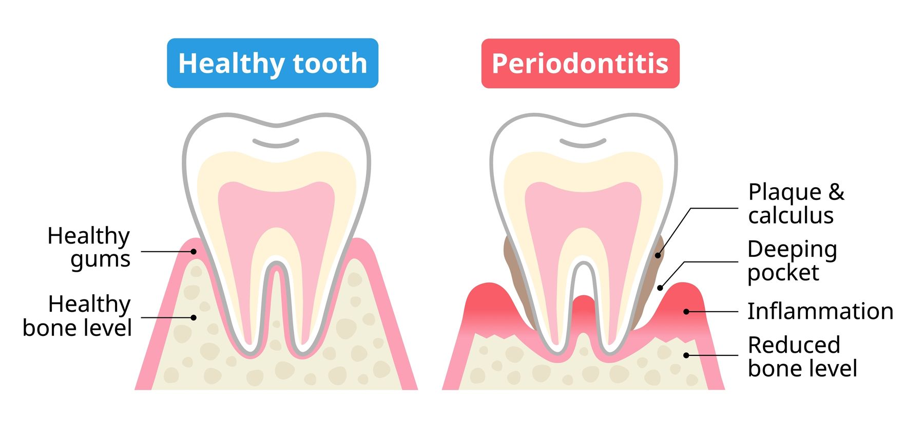 Healthy tooth vs a tooth with periodontal disease