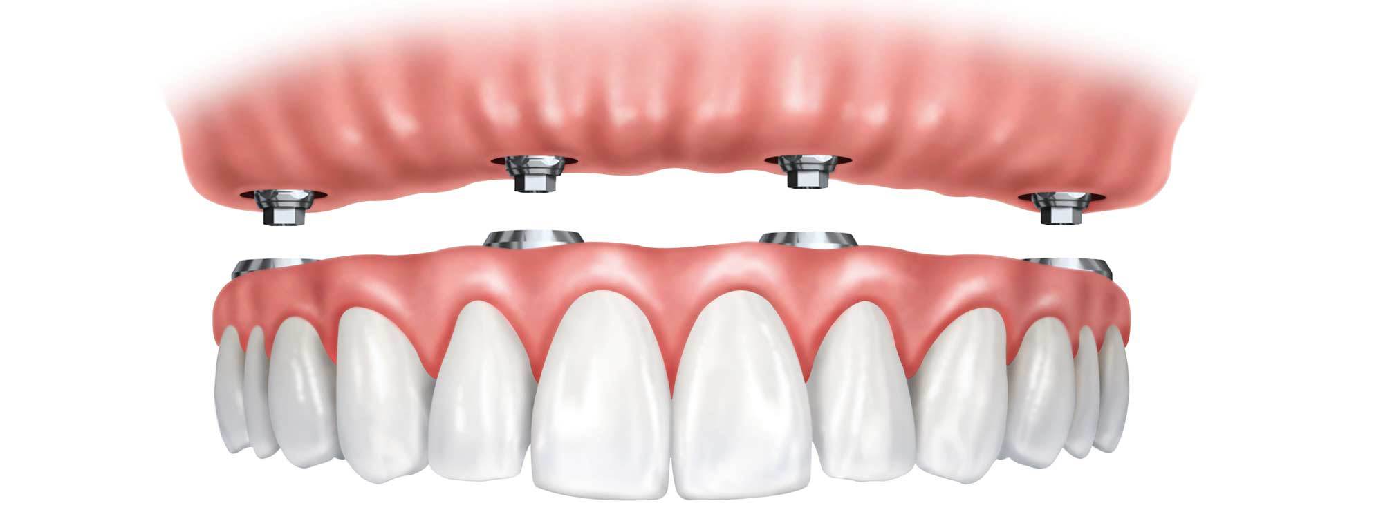 Implant Overdentures by Nassau County Periodontist Dr. Stephanie Sfiroudis DDS, MS