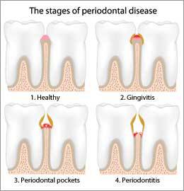 Treatment of Periodontal Disease by Nassau County Periodontist Dr. Marichia Attalla would be needed for the gum disease shown.