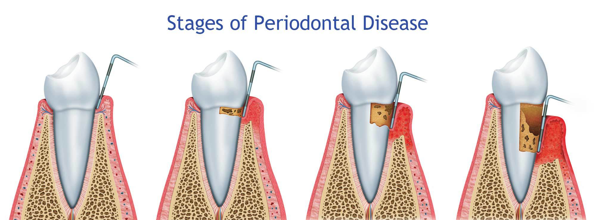 Periodontal Disease Treatment by Nassau County Periodontist Dr. Stephanie Sfiroudis