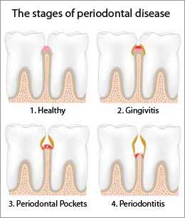 The stages of Periodontal Disease for gums in need of treatment of Gingivitis by Nassau County Periodontist, Dr. Marichia Attalla in Williston Park, NY 11596
