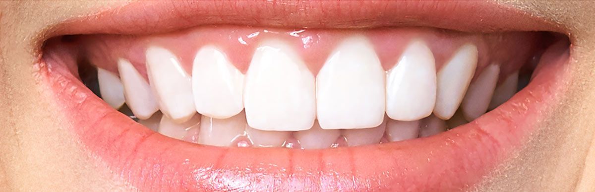 Client after professional teeth whitening