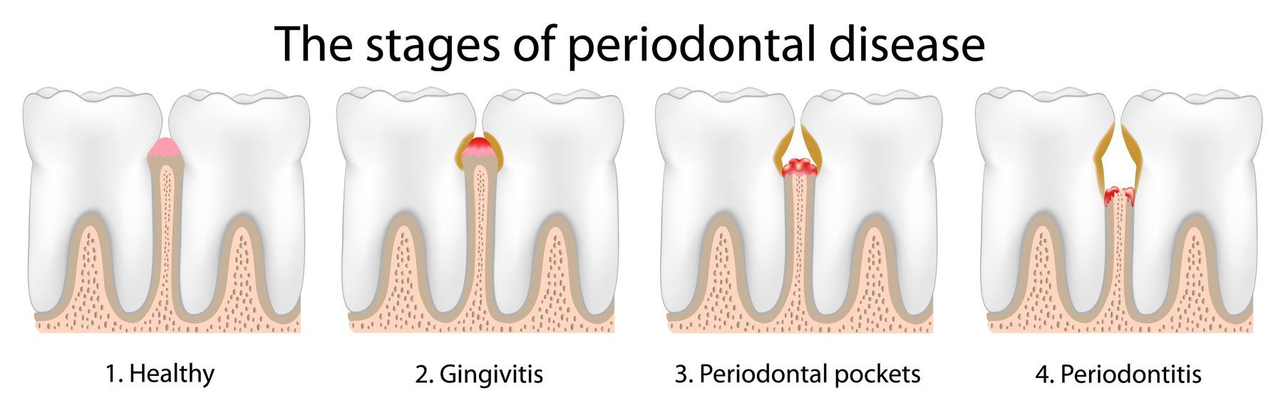Periodontal Disease Treatment by Nassau County Periodontist Dr. Stephanie Sfiroudis