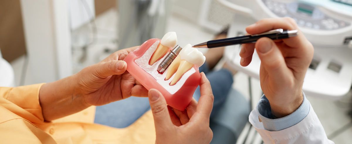 When to Consider Dental Implants