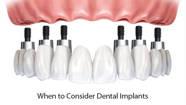 When to Consider Dental Implants