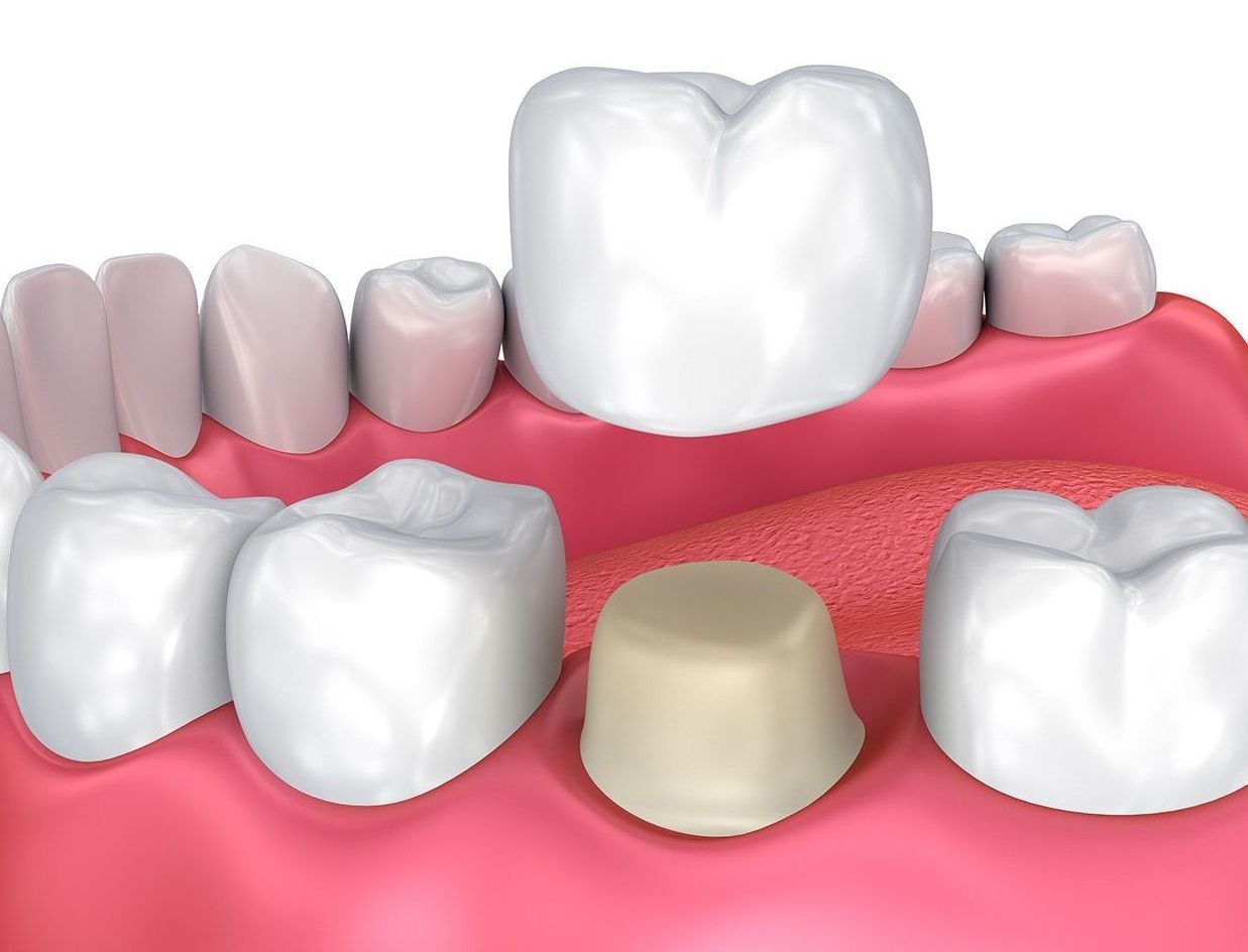 Graphic of teeth and crown