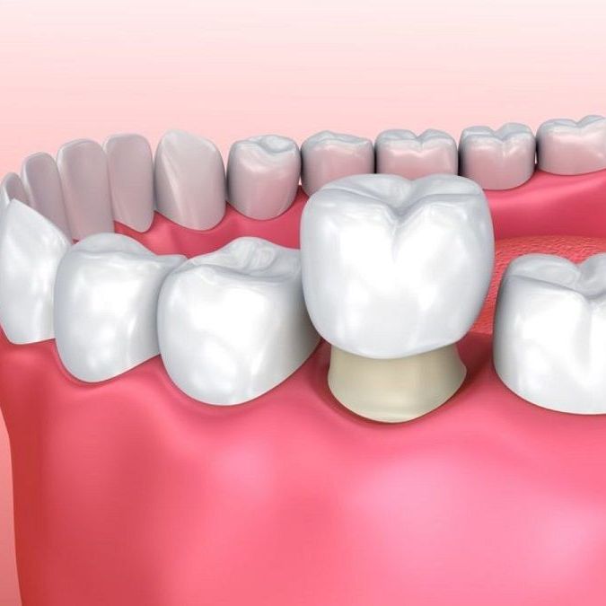 Dental implant is applied over natural tooth
