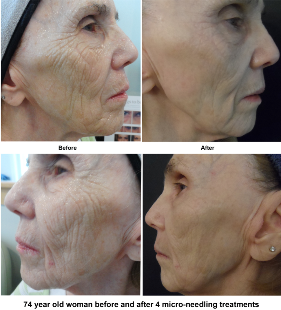 A 74 year old woman before and after 4 micro needling treatments