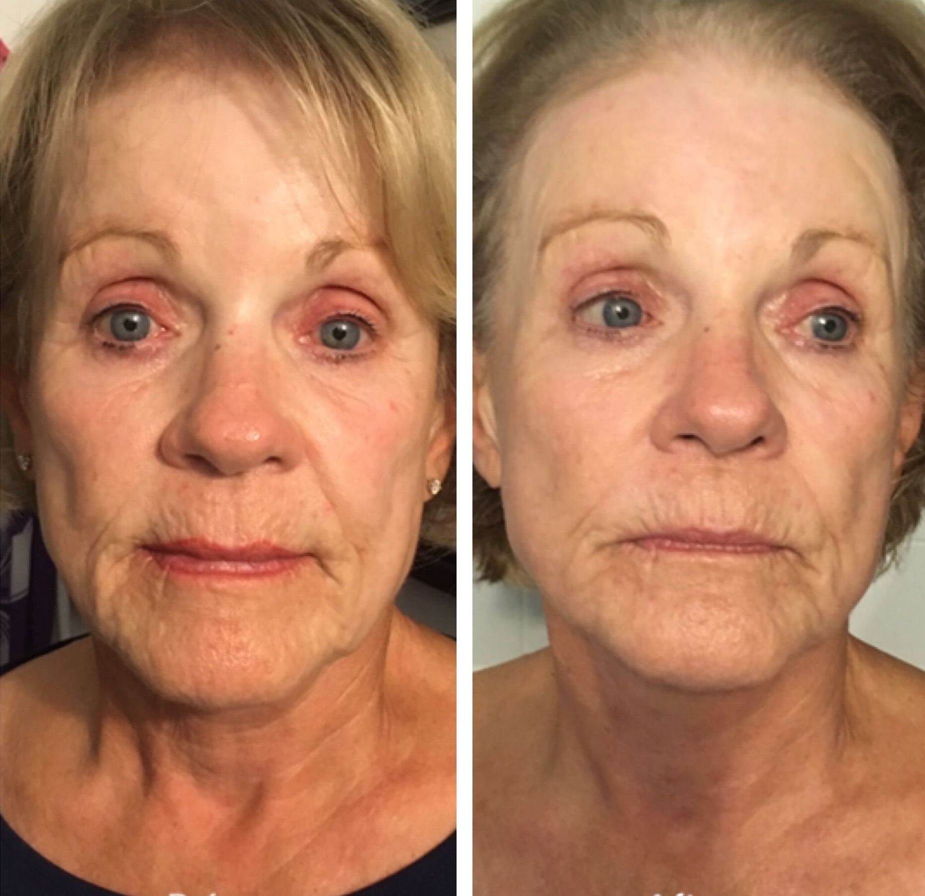 A before and after photo of a woman 's face