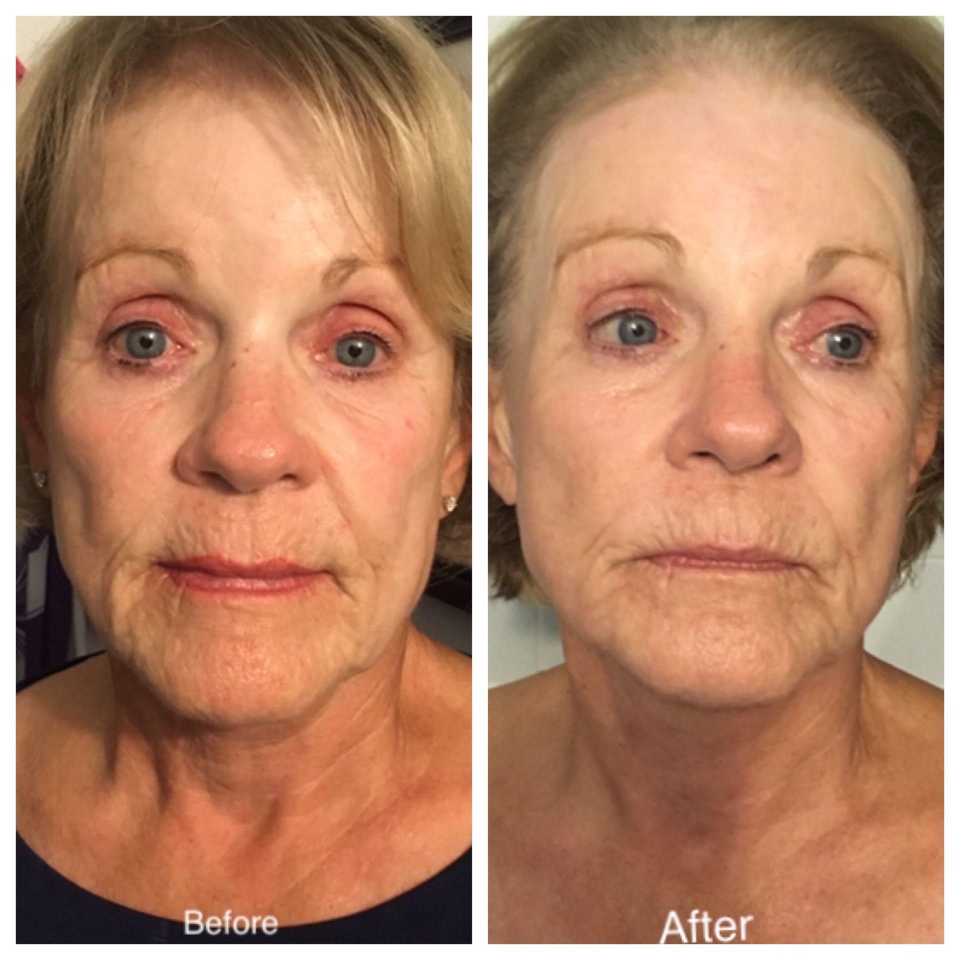 A before and after photo of a woman 's face.