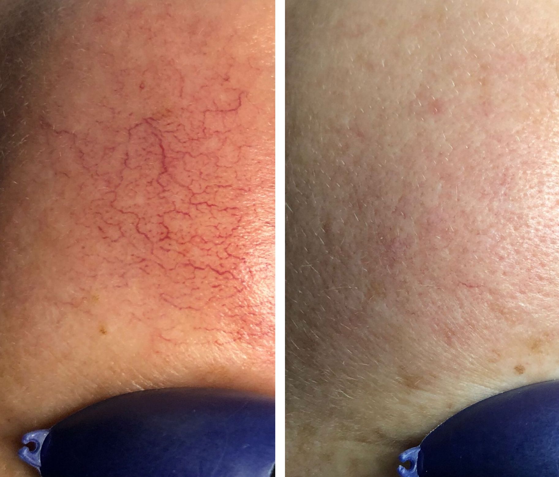 A before and after photo of a person 's face with red veins.