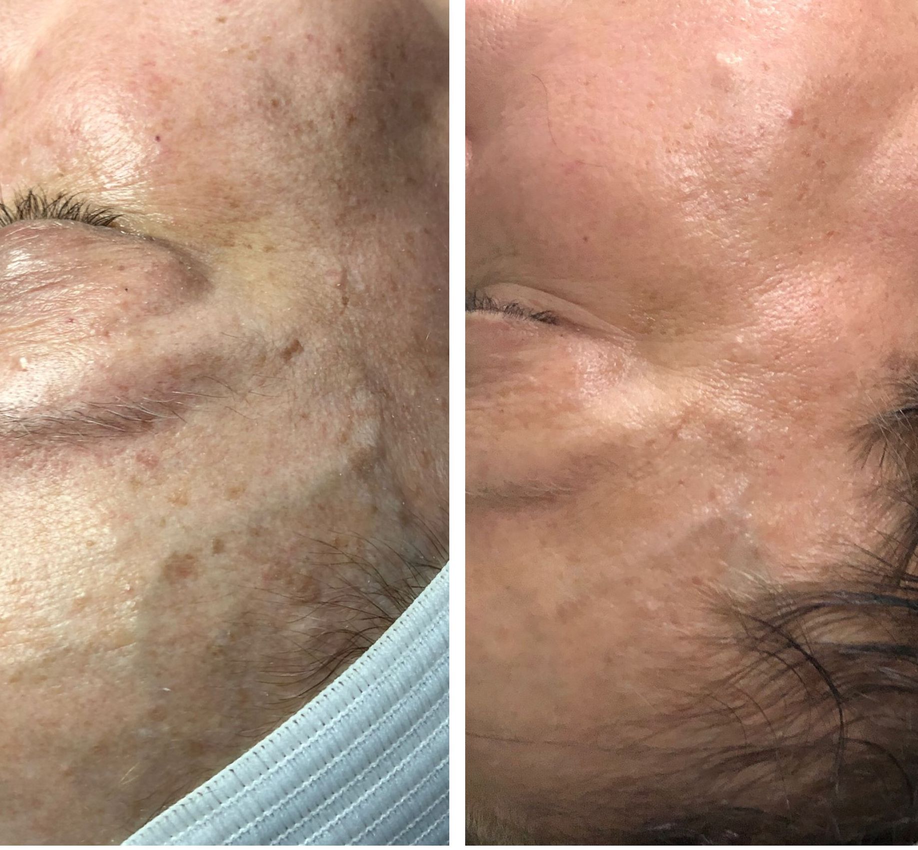 A before and after picture of a woman 's face.