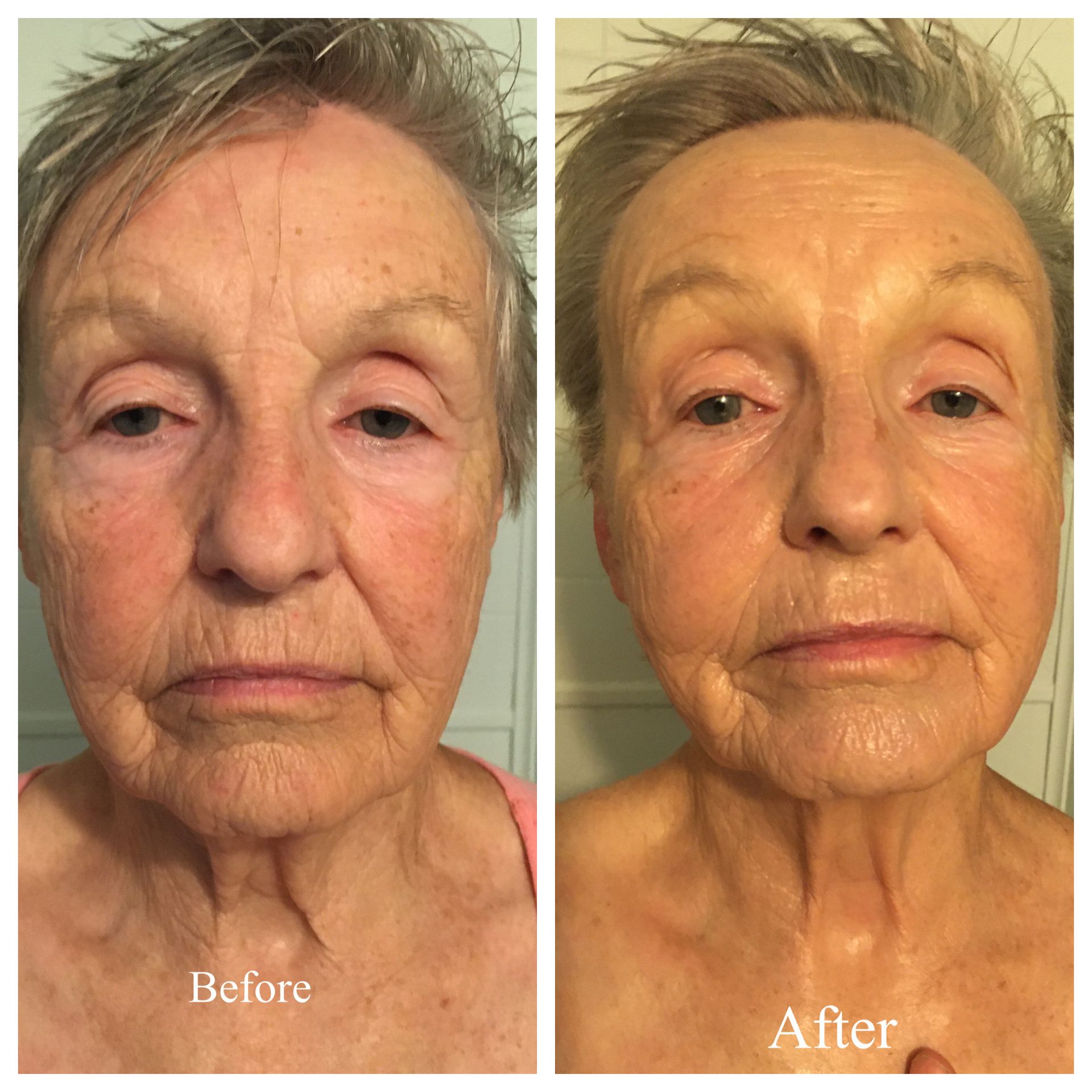 A before and after photo of an older woman 's face.