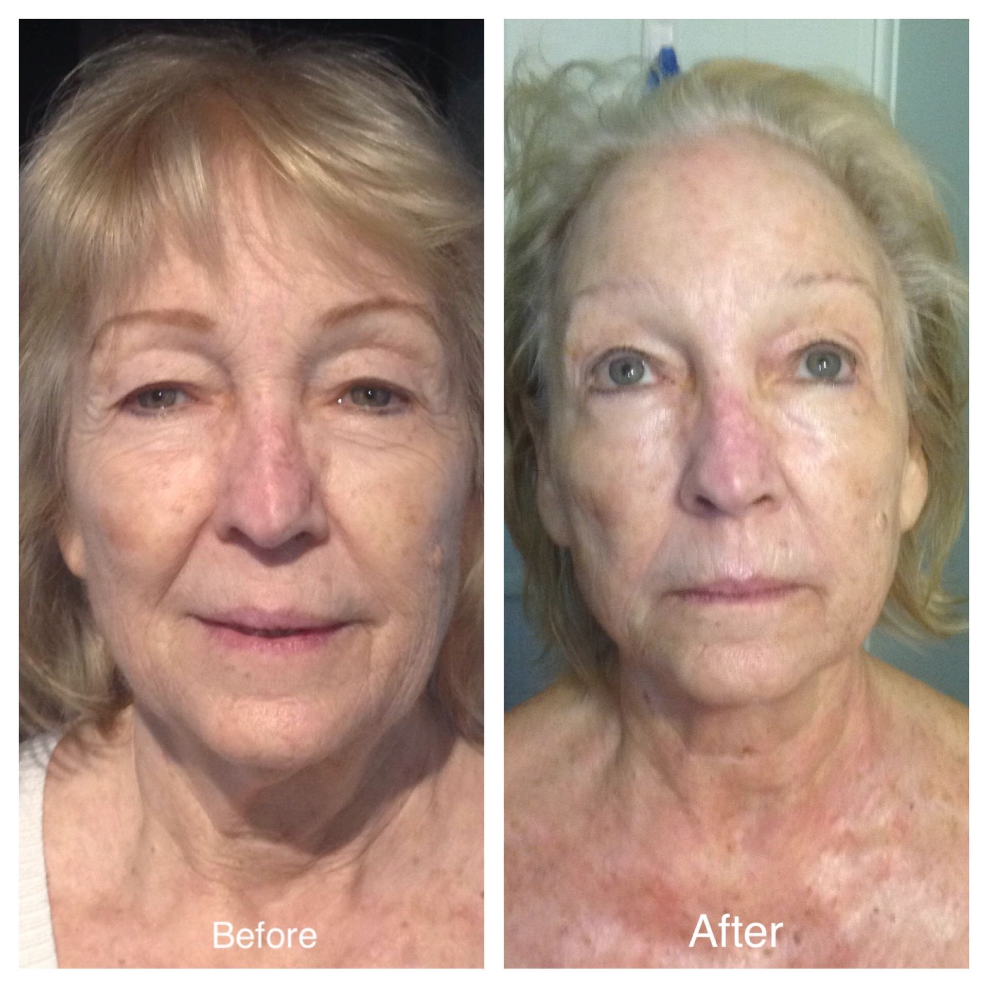 A before and after photo of a woman 's face.
