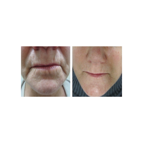 A before and after photo of a woman 's face with wrinkles.