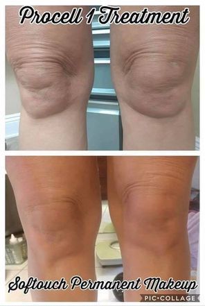 A before and after photo of a woman 's knee with procell 1 treatment and softtouch permanent makeup.