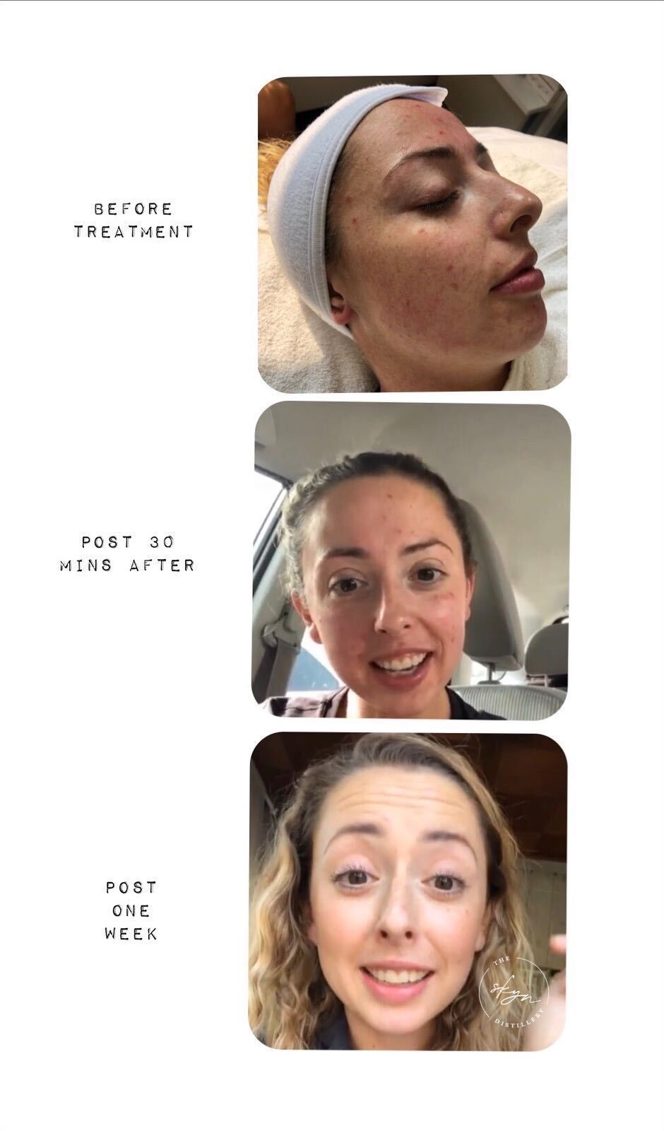 A woman 's face is shown before and after a treatment.
