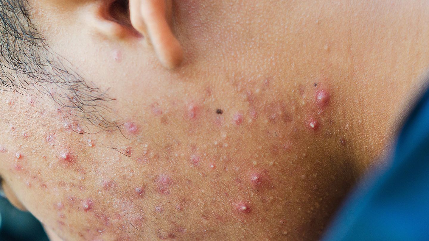 A close up of a man 's face with acne on it.
