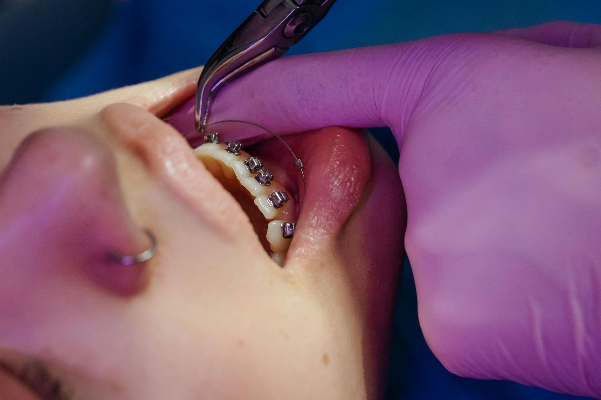 A woman with braces is getting her teeth examined by a dentist.