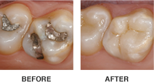 Before and After Cerec