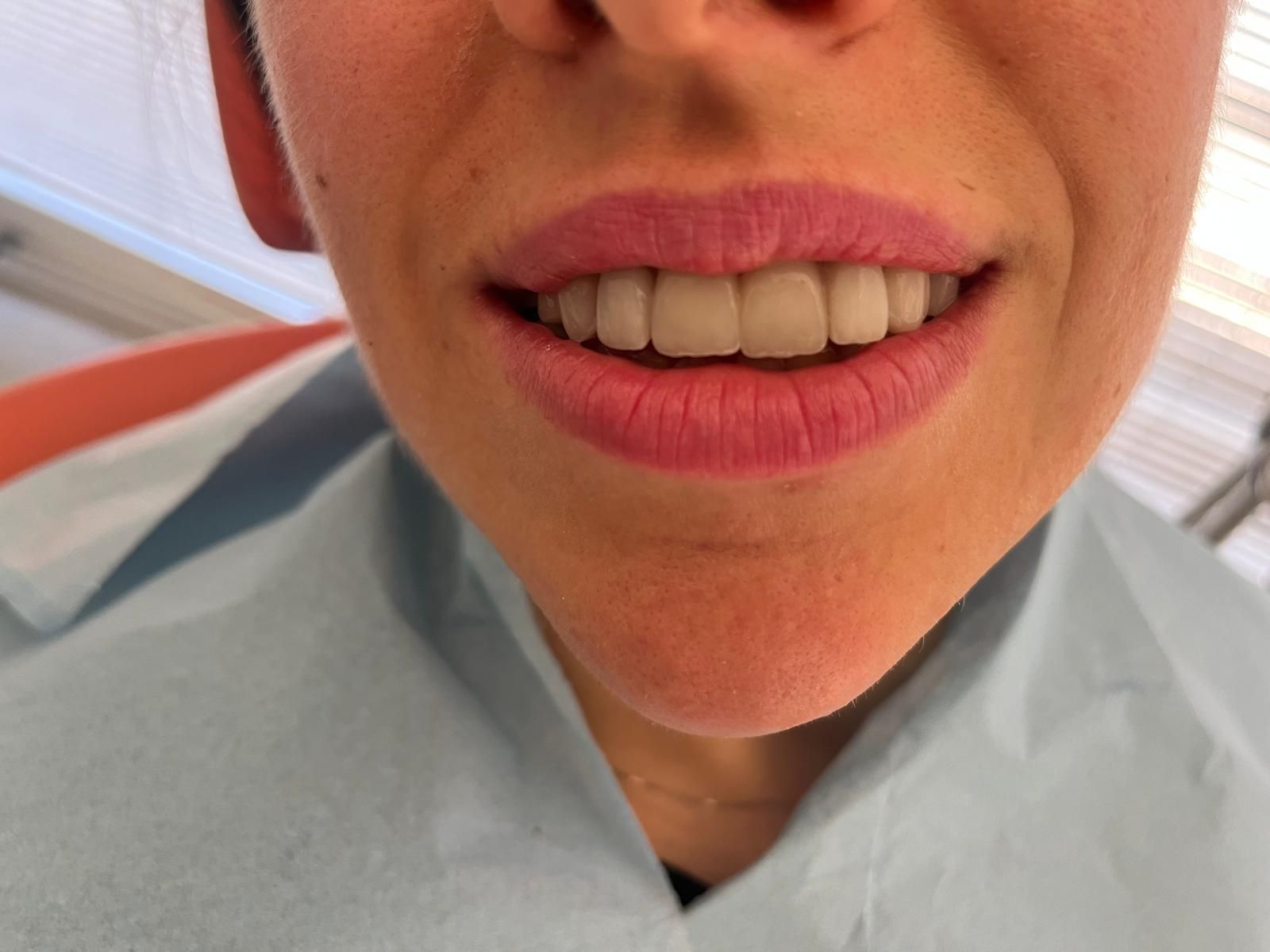 Esempio di riabilitazione protesica dell’arcata superiore con n. 6 faccette dentali da canino a canino