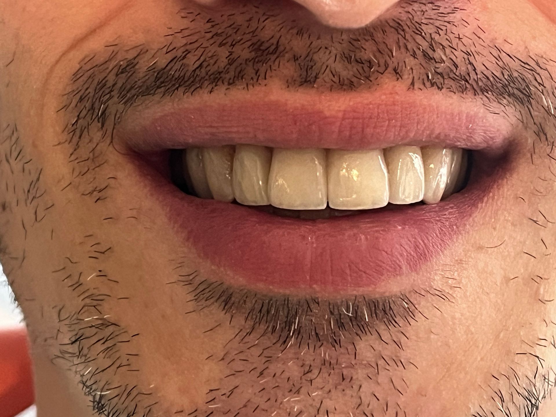 Riabilitazione protesica con corone in zirconio altamente estetiche