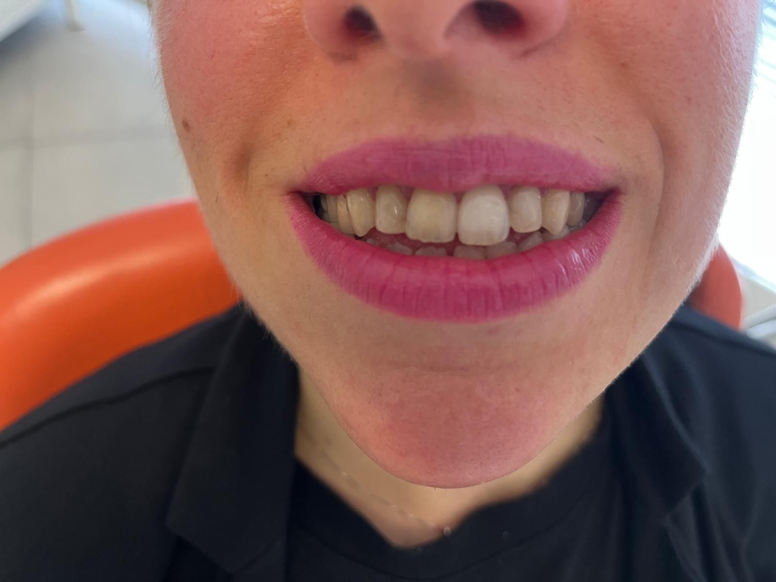 Esempio di riabilitazione protesica dell’arcata superiore con n. 6 faccette dentali da canino a canino