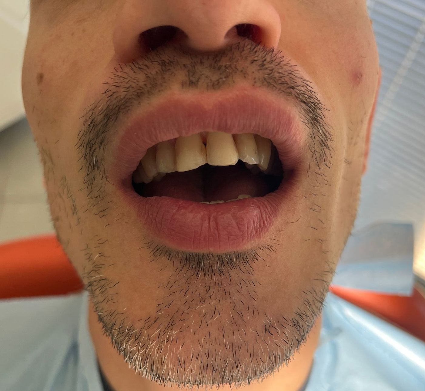 Riabilitazione protesica con corone in zirconio altamente estetiche