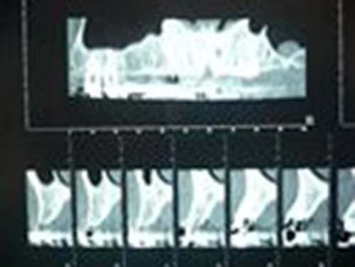 implantologia Perugia