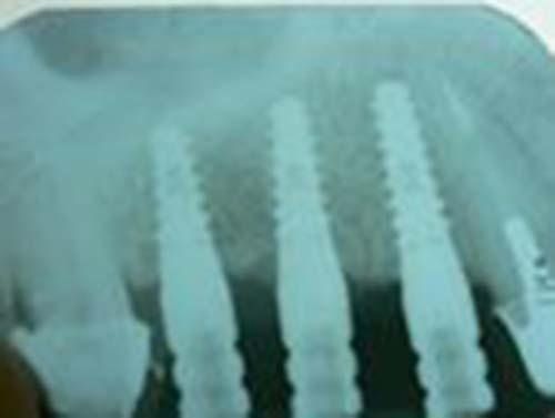 implantologia Perugia