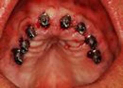 implantologia Perugia