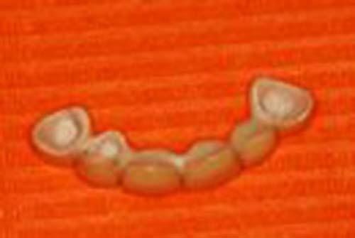 protesi mobili e fisse