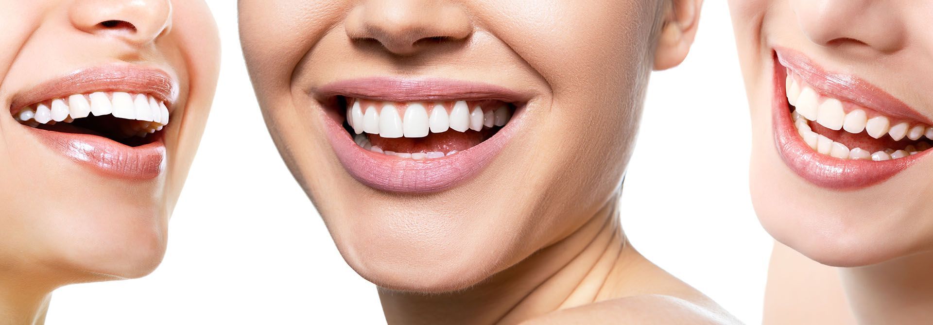 SBIANCAMENTO DENTALE