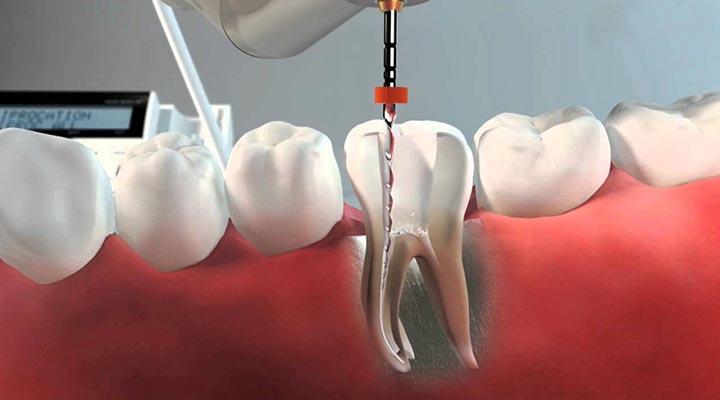CENTRO DE IMPLANTOLOGÍA DENTAL OSEOINTEGRADA Y ORTODONCIA - EXTRACCIONES
