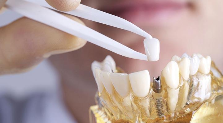 CENTRO DE IMPLANTOLOGÍA DENTAL OSEOINTEGRADA Y ORTODONCIA - PROTESIS BUCAL
