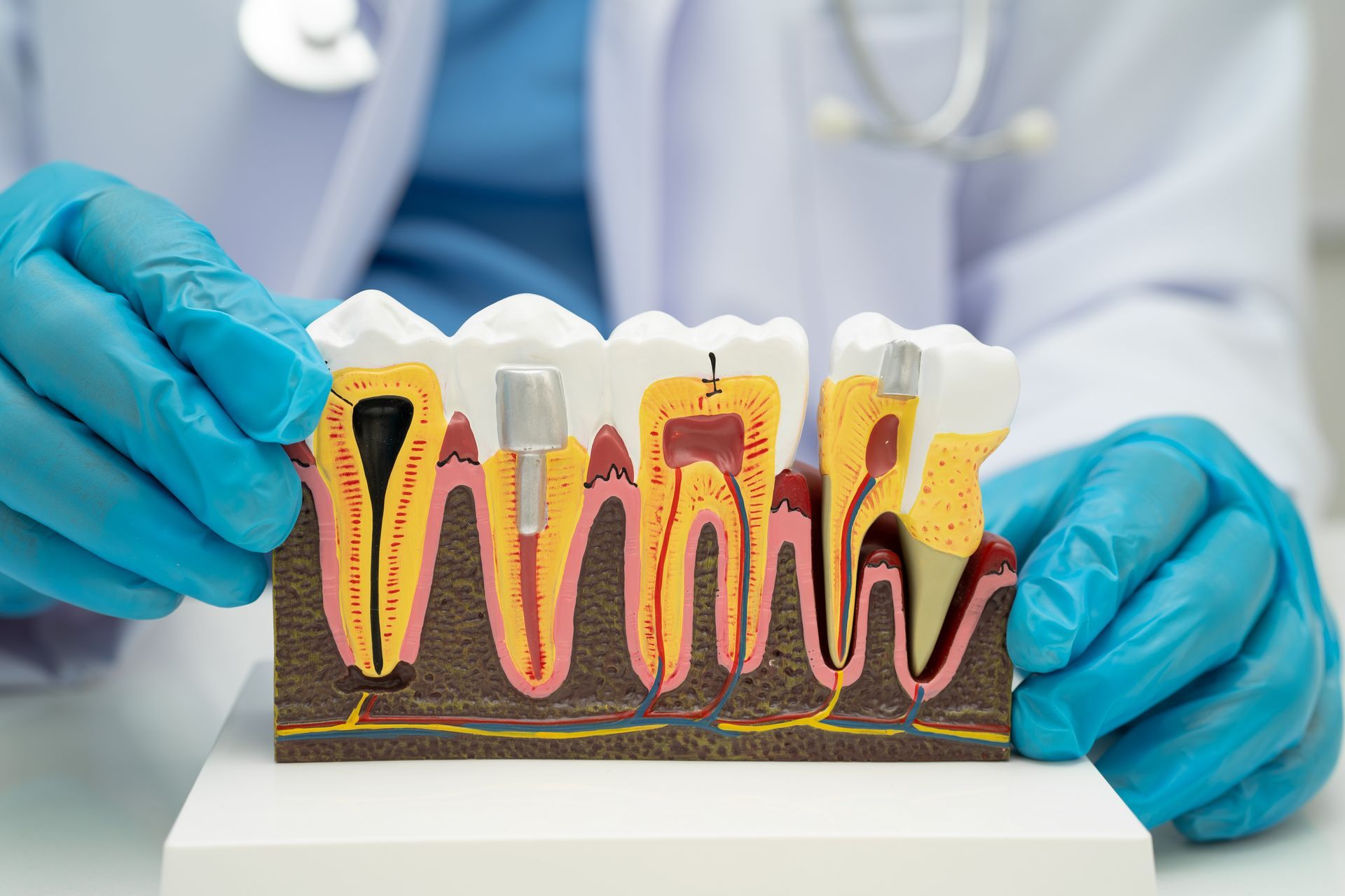 Gloved hands holding a dental model showing cross-sections of teeth and roots.