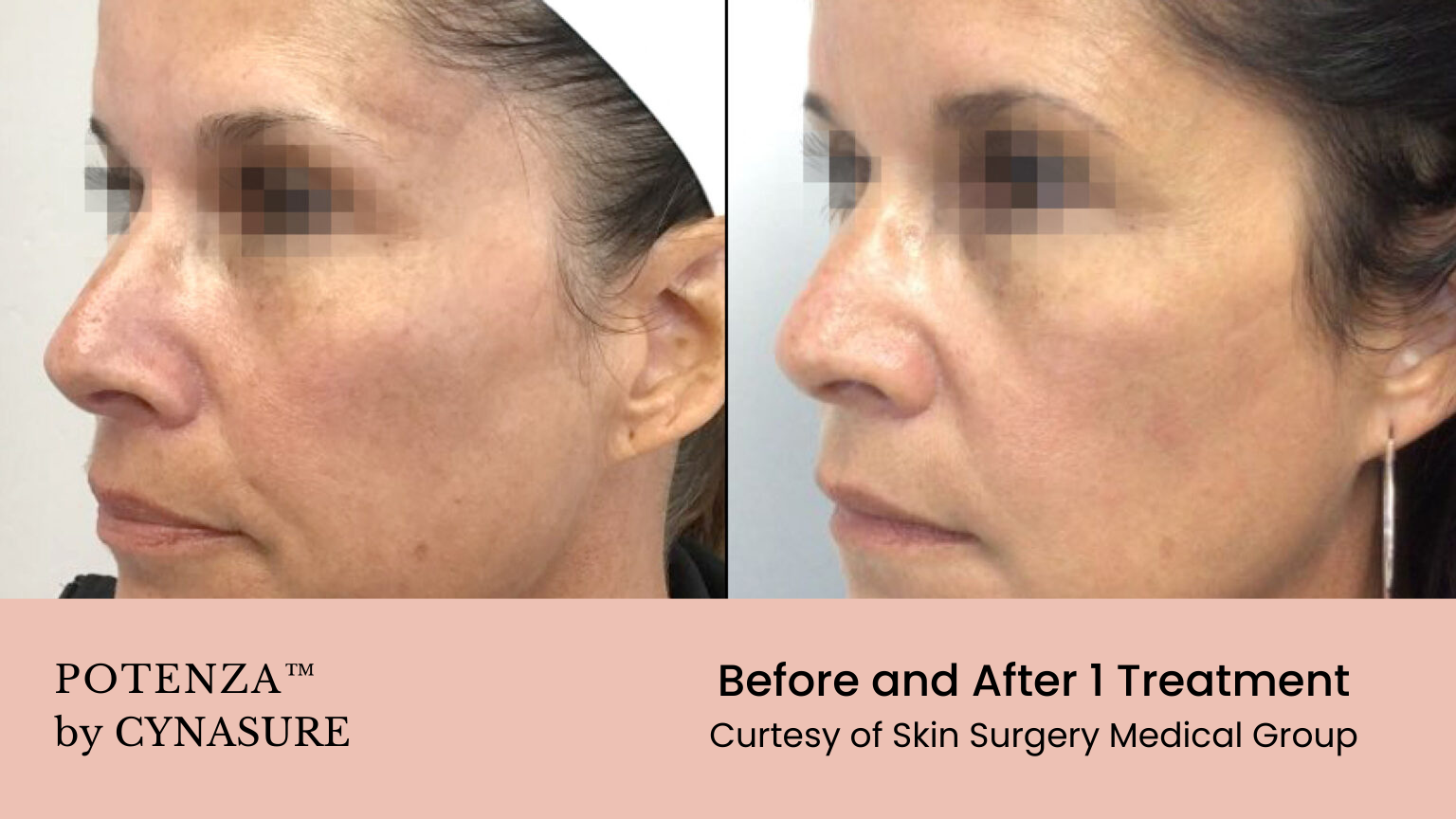 A woman 's face is shown before and after a treatment by cynasure