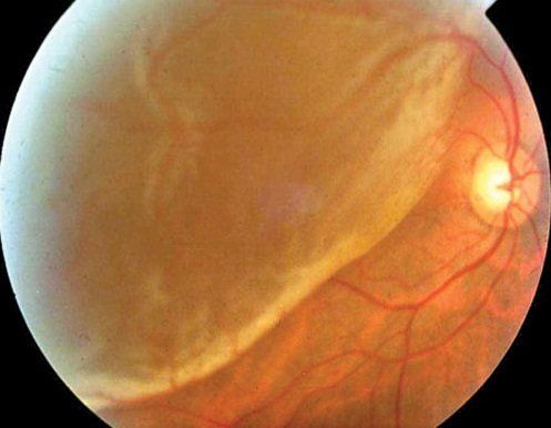 Distacco della retina