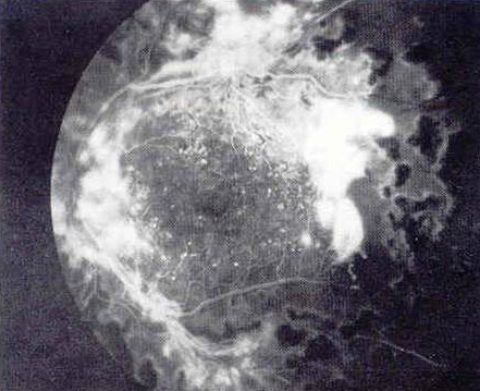 Angiografia fluoresceinica di un occhio, che mostra i vasi sanguigni della retina con aree di perdite e gonfiore.