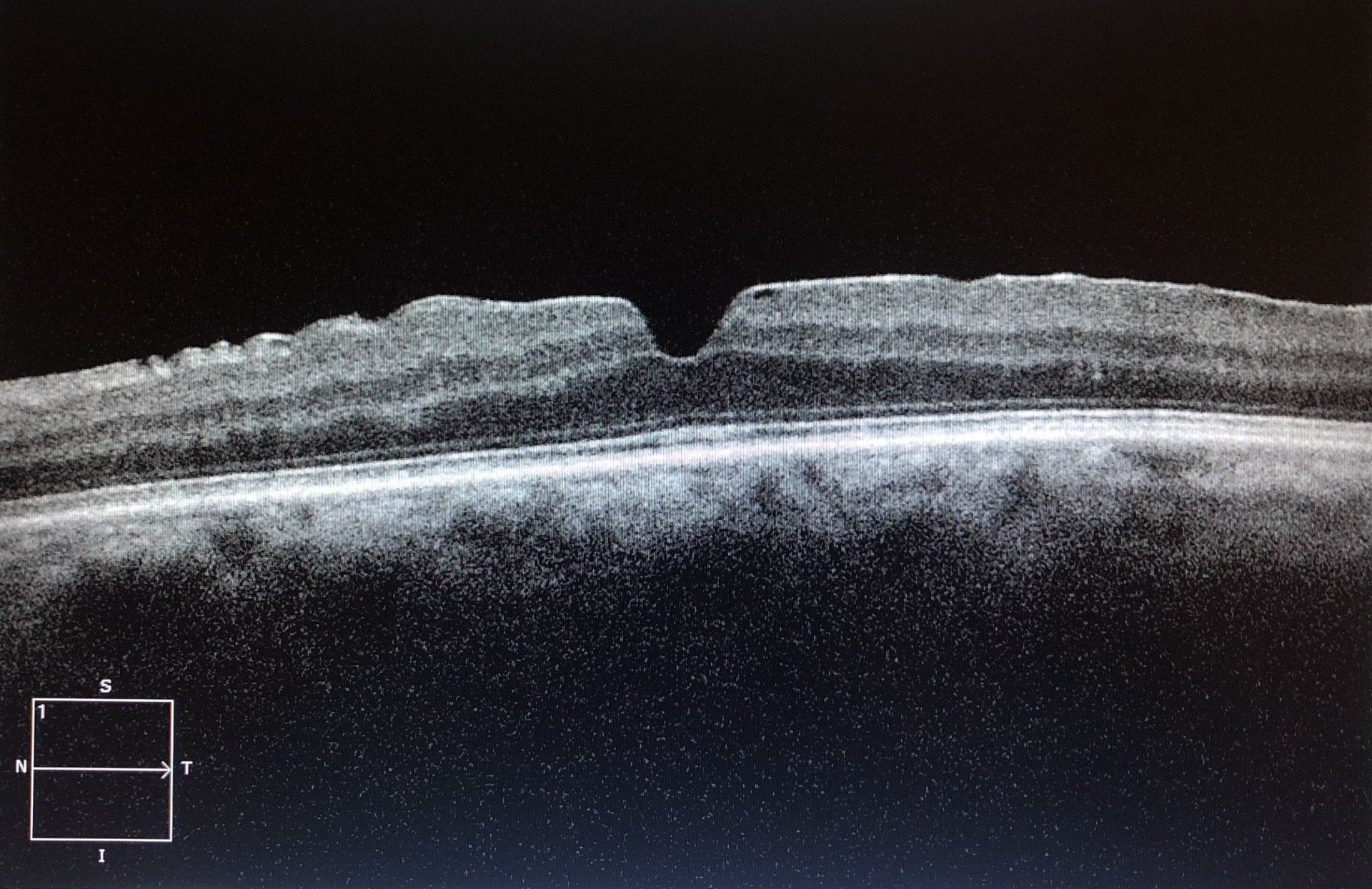 Sintomi puker maculare