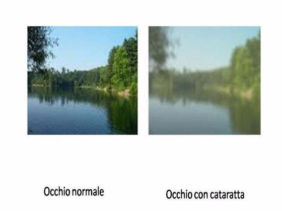 Confronto tra la vista normale (nitida) e la vista con cataratta (sfocata) di un paesaggio lacustre.